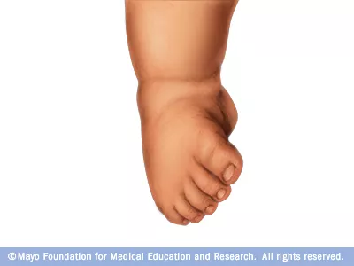 Why does my baby's foot turn inward?