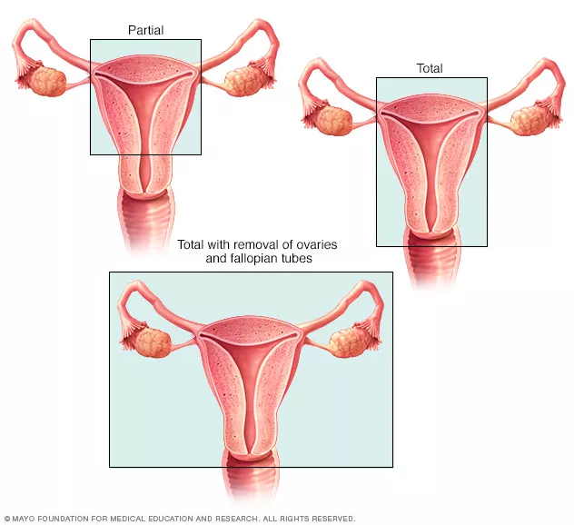 how many follow up visits after hysterectomy