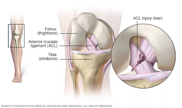 Se puede conducir con el ligamento cruzado anterior roto